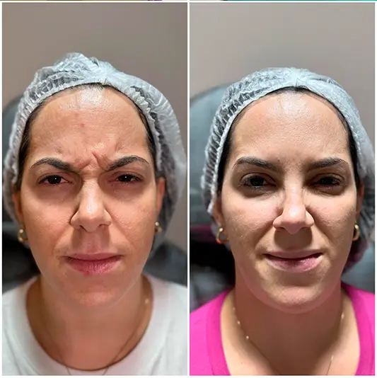 Botox