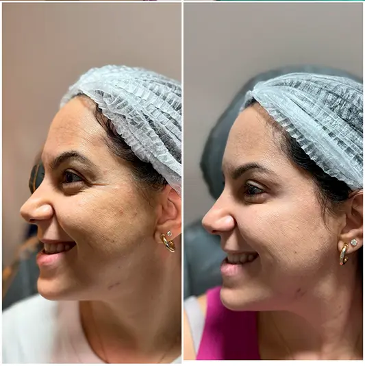 Botox