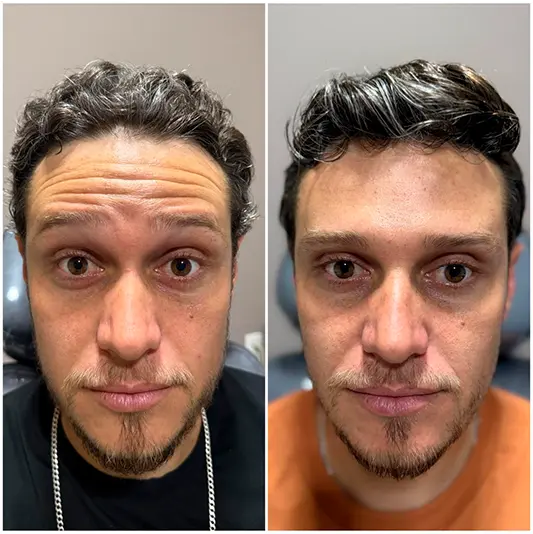 Botox