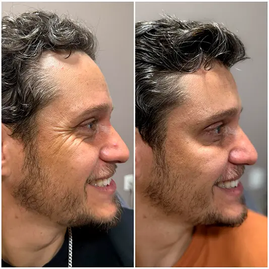 Botox